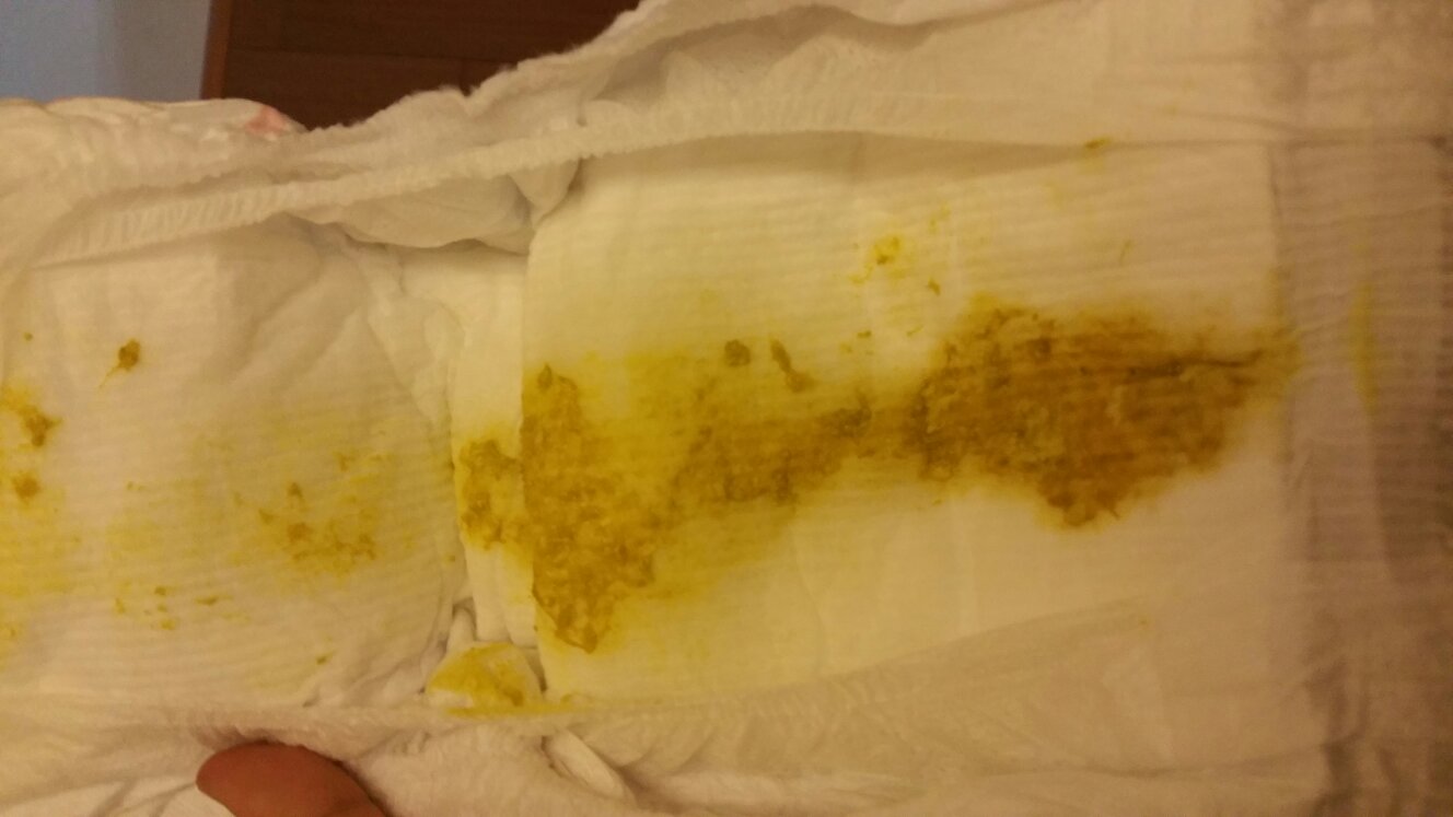 借卵供卵低费用生的宝宝大便干燥带血怎么办_借卵供卵低费用生的宝宝大便干结带血怎么办
