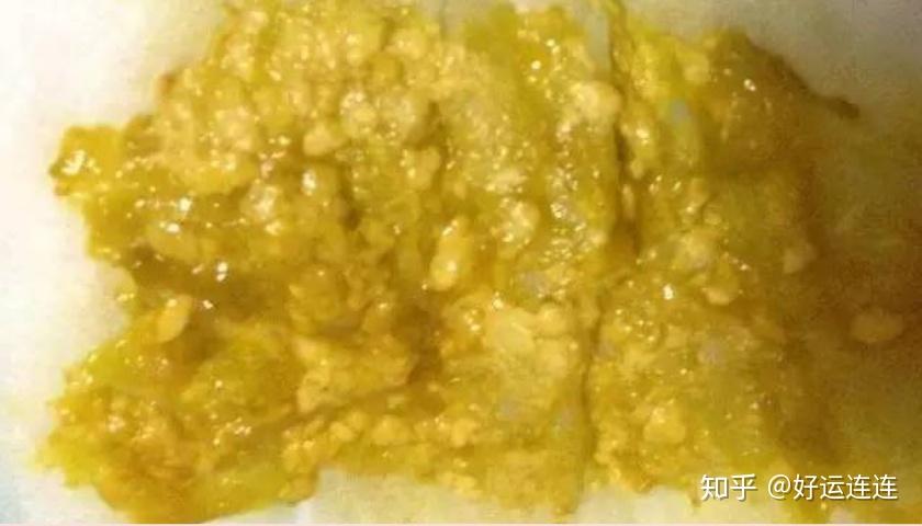借卵供卵低费用生的宝宝大便干燥带血怎么办_借卵供卵低费用生的宝宝大便干结带血怎么办